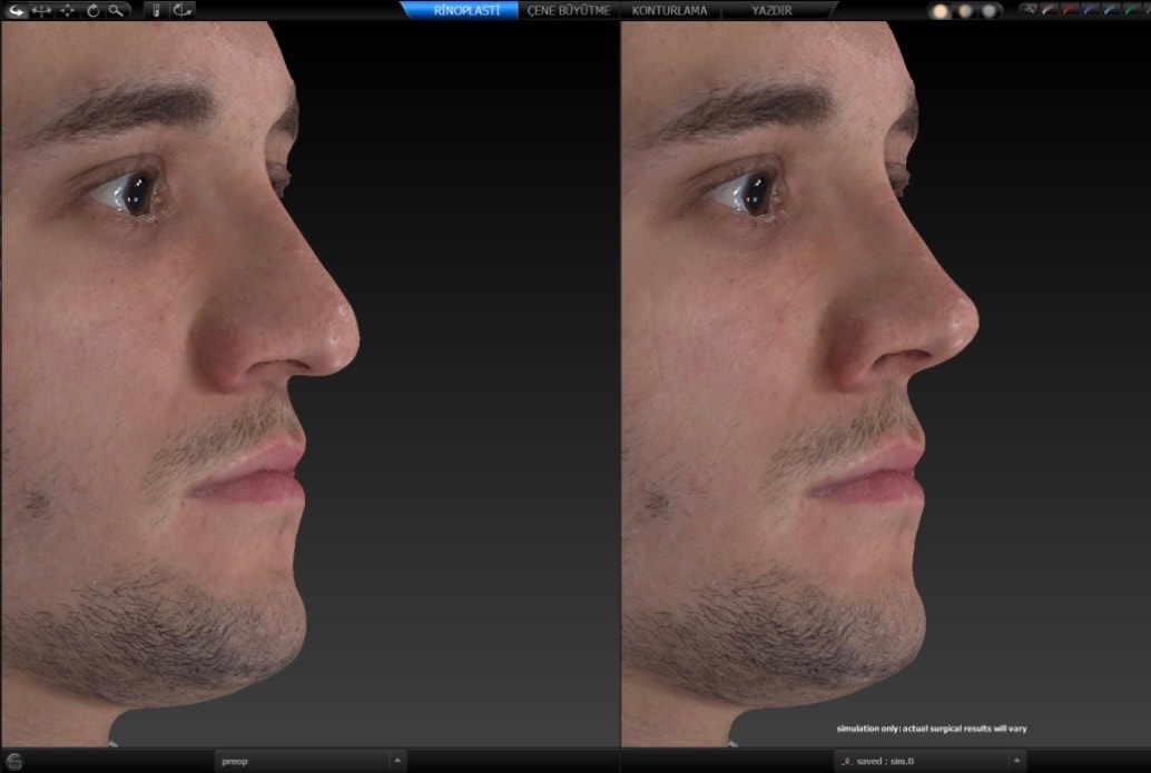 Burun simülasyonu