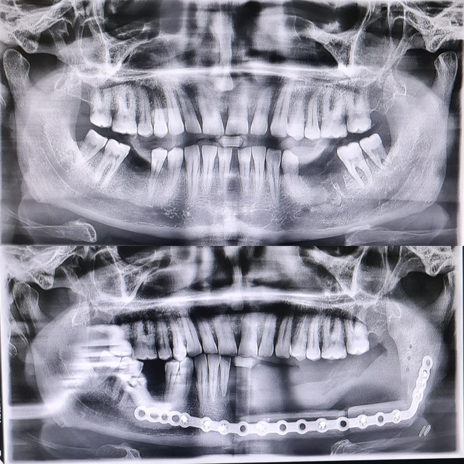 Radiographie panoramique dentaire avant (en haut) et après (en bas) une reconstruction de la mandibule par le péroné (fibula) ; on voit les plaques et les vis qui fixent l’os transféré