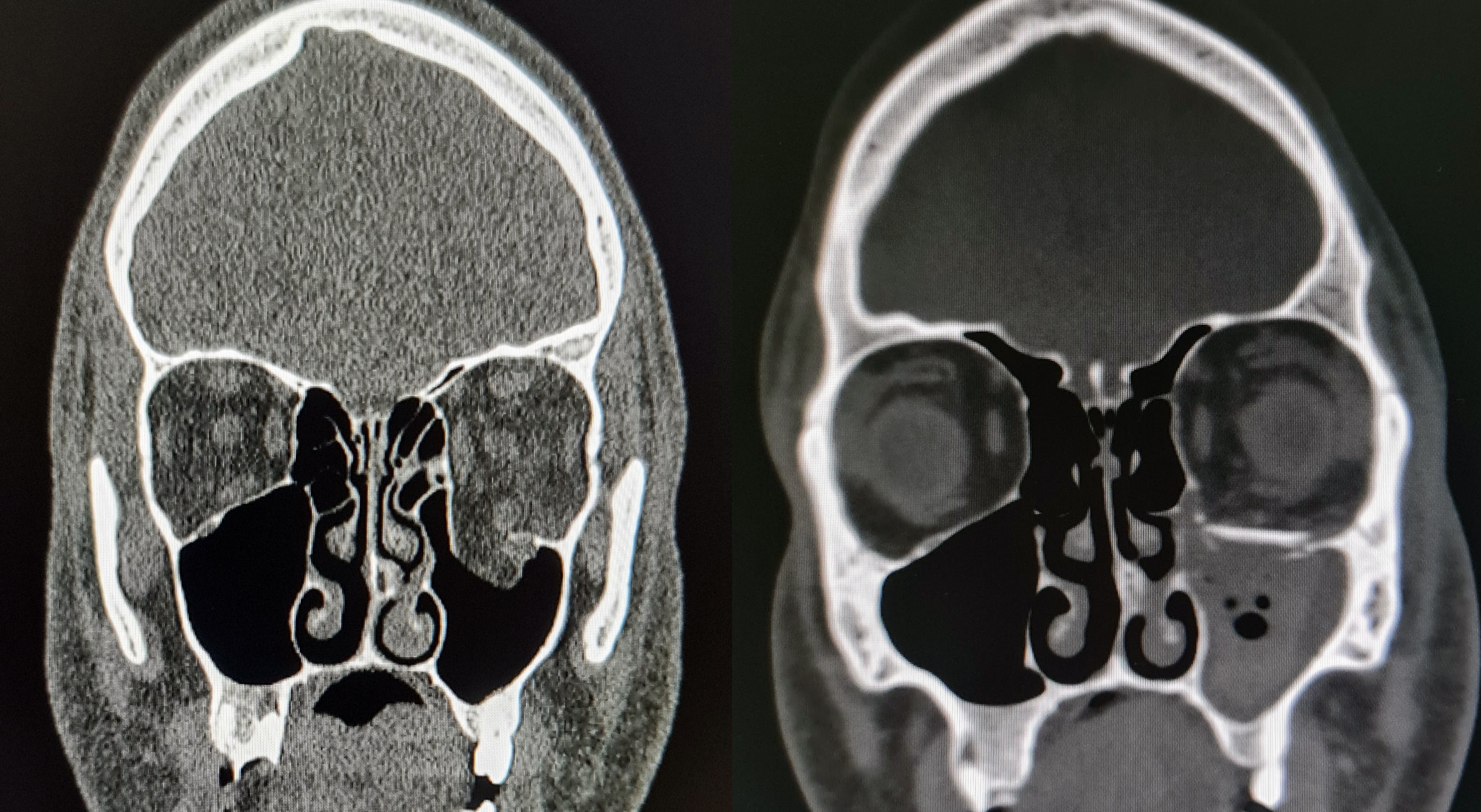 Coupes coronales de scanner avant et après la réparation d’une fracture du plancher de l’orbite